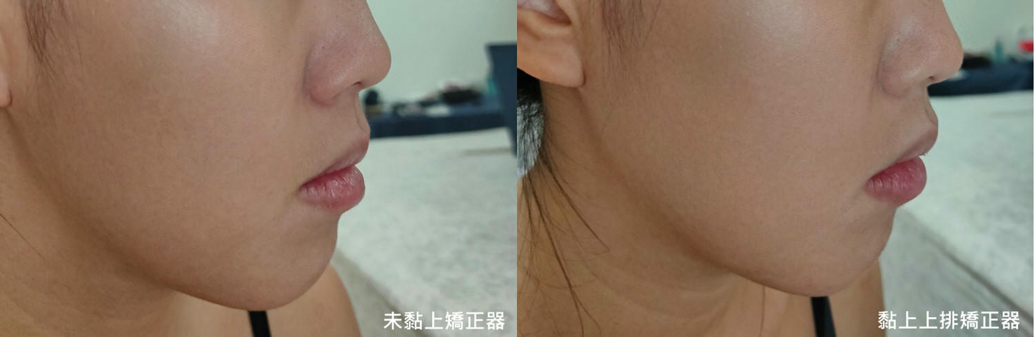 【牙套日記】矯正篇：黏上矯正器！正式踏上戽斗人的純矯正之路！