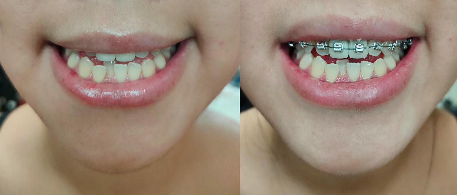 【牙套日記】矯正篇：黏上矯正器！正式踏上戽斗人的純矯正之路！